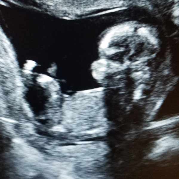 2D Ultrasound